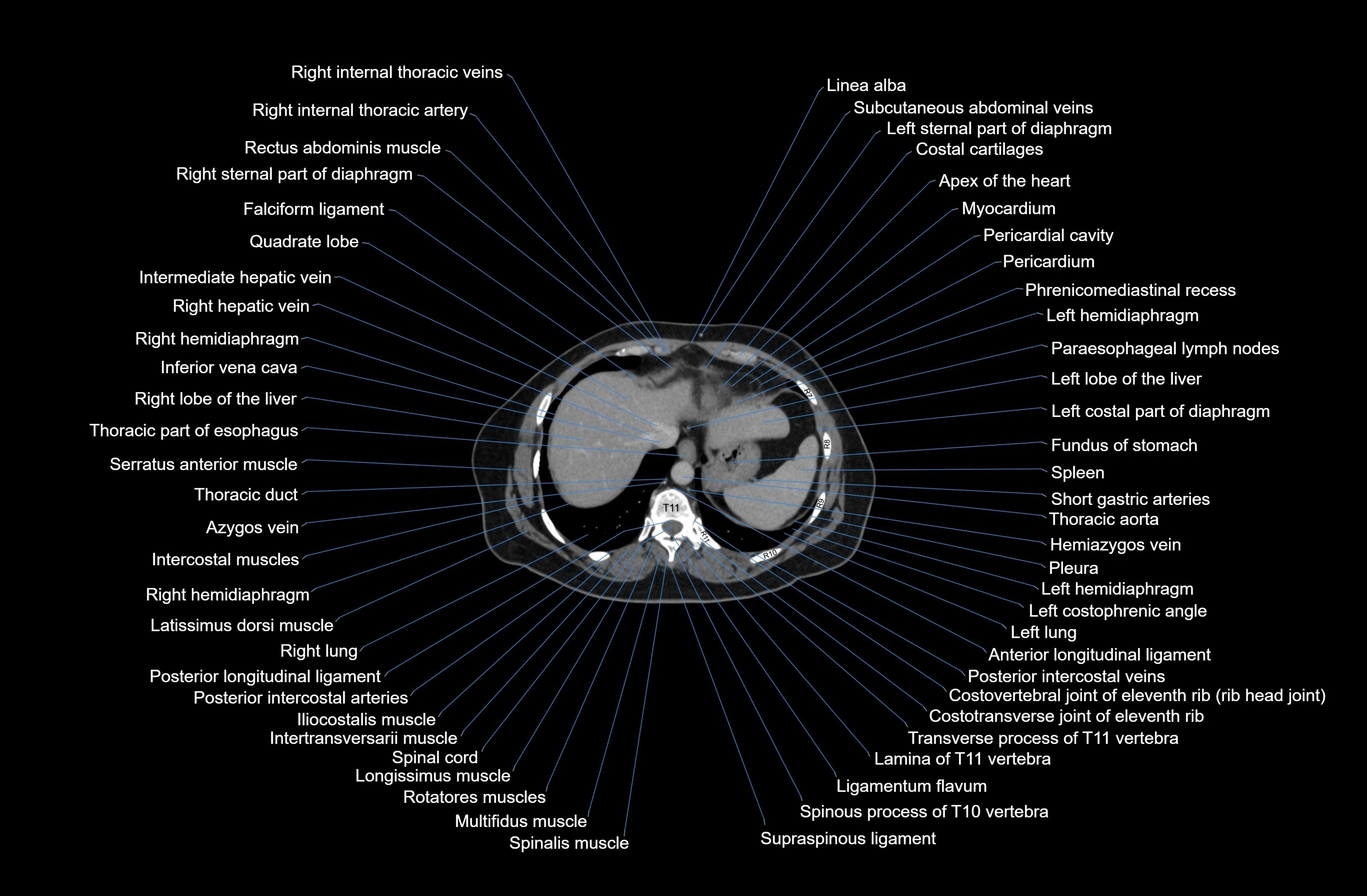 CT Abdomen axial cross sectional anatomy labelled radiology image-00010.webp